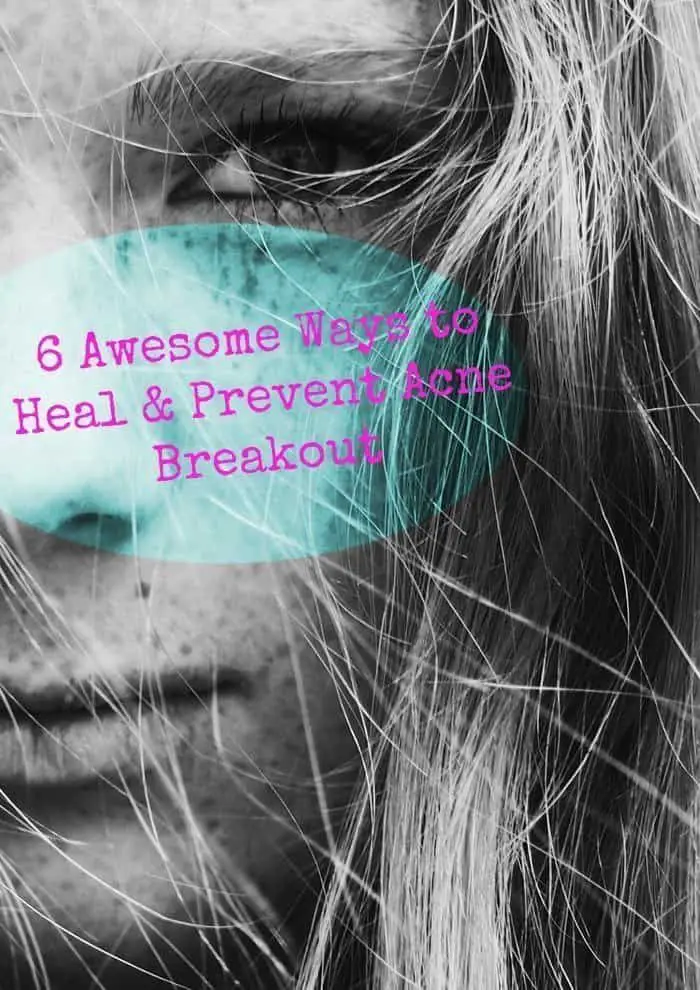 6 Awesome Ways to Prevent and Heal Acne Breakouts