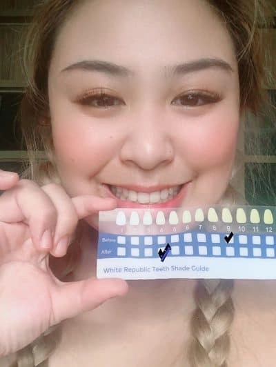 How Did White Republic Teeth Whitening Kit Hold Up When I Tried It?