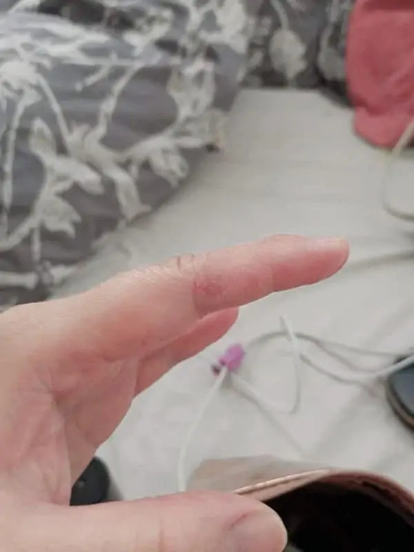 finger-with-eczema